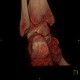 Atypical fracture of calcaneus, fracture: CT - Computed tomography